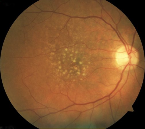 Fundus photograph showing drusen in age-related macular degeneration