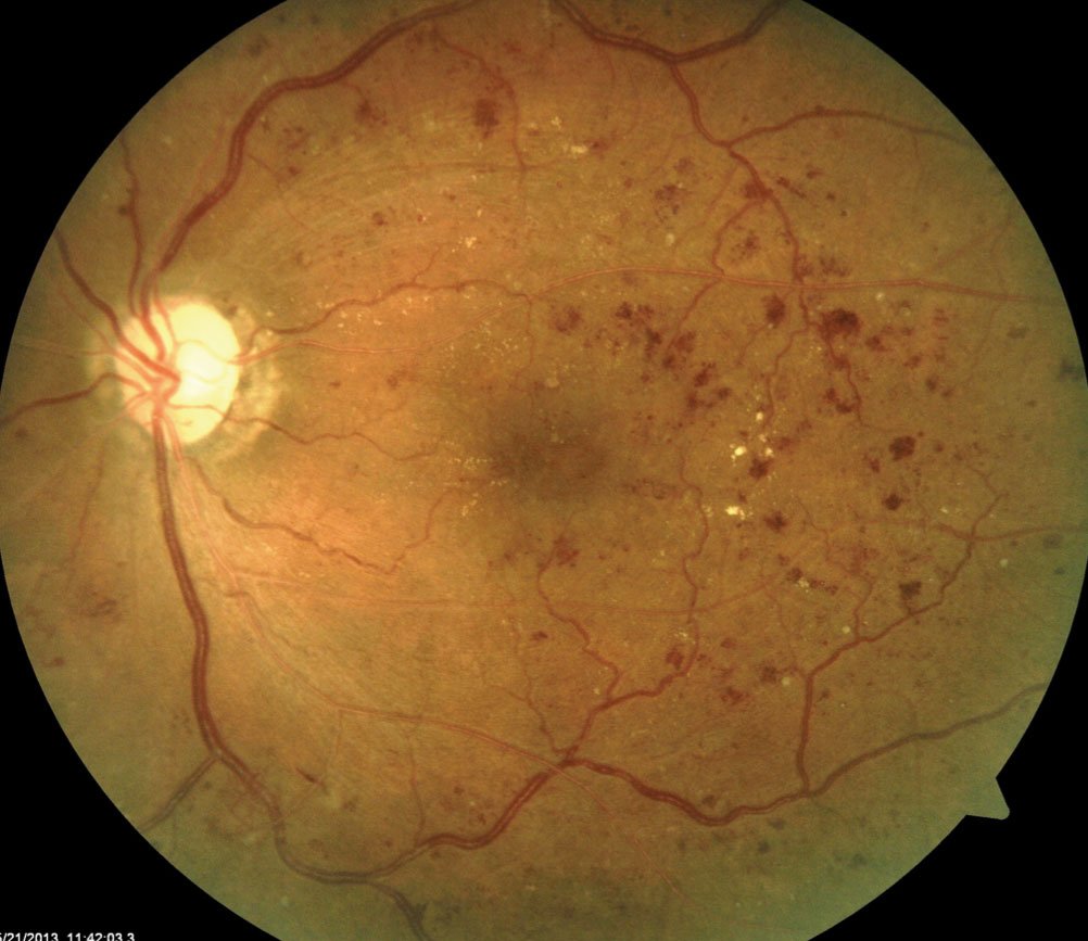 Fundus photograph showing haemorrhages and exudates in diabetic retinopathy