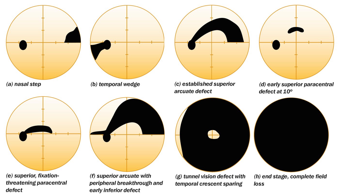Visual field patterns showing the progression of glaucomatous vision loss