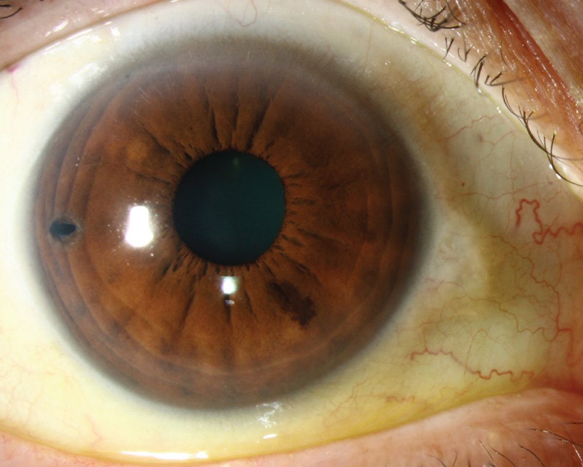 Close-up photograph of an eye showing a laser peripheral iridotomy opening in the peripheral iris