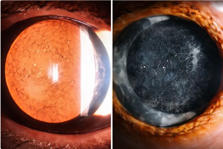 Comparison images showing a clouded posterior capsule behind an intraocular lens implant