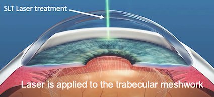 Illustration showing selective laser trabeculoplasty being applied to the trabecular meshwork