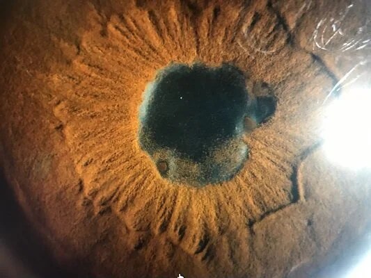 Slit lamp photograph showing posterior synechiae — adhesions binding the iris to the lens surface — causing an irregular pupil in anterior uveitis
